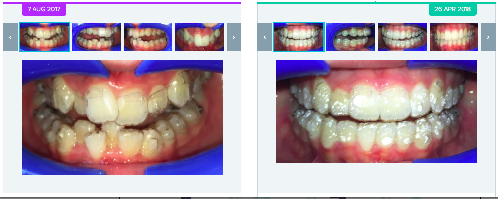 Artificial Intelligence (AI) driven customised orthodontics is the future