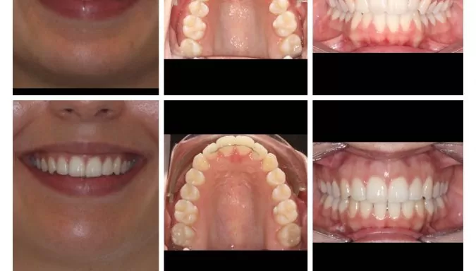 Amazing 6-month Smile Transformation