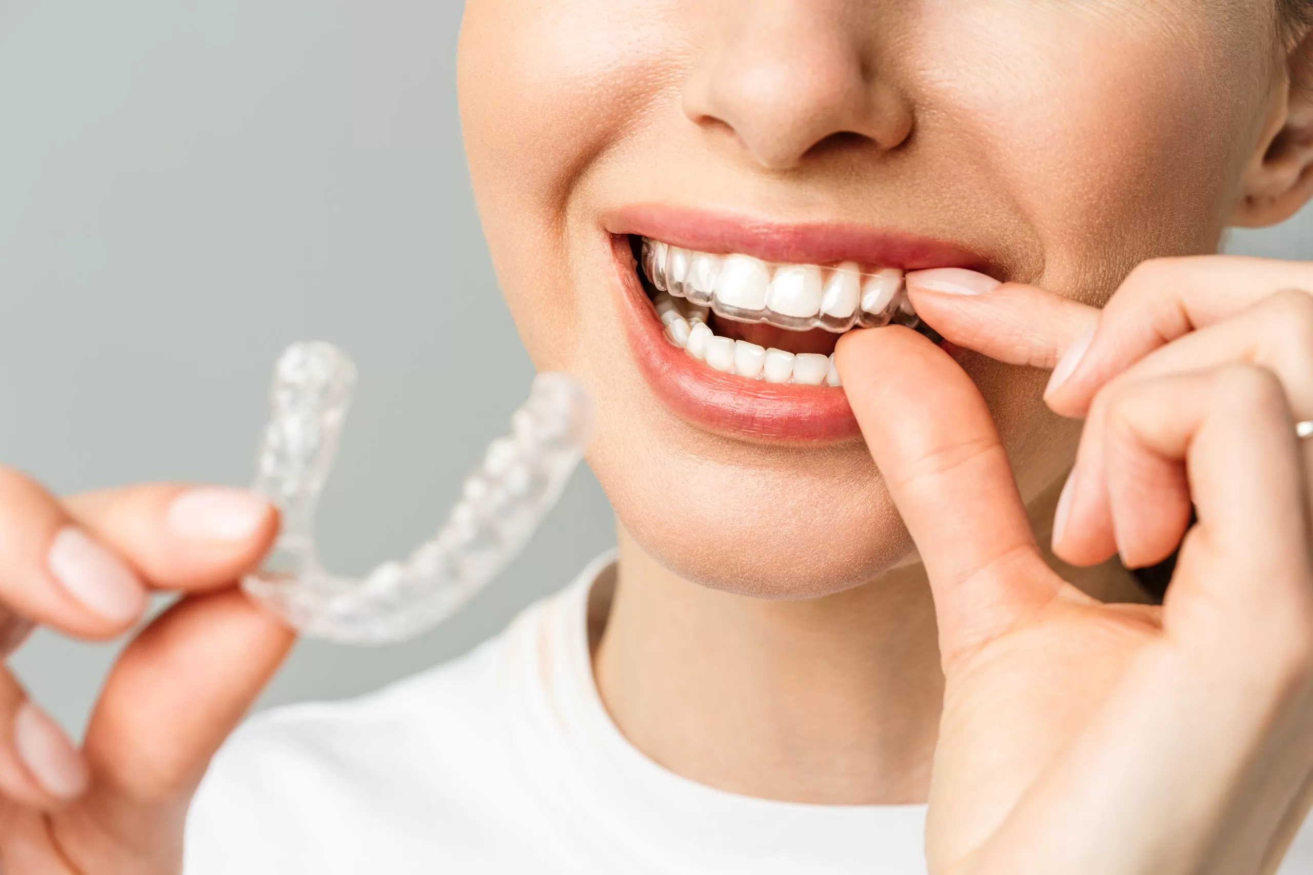 A young woman does a home teeth whitening procedure. Whitening tray with gel